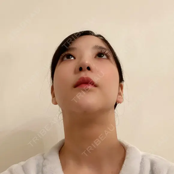 骨削り（頬） / 脂肪吸引（顔） / ボトックス（エラ・小顔） / ボトックス（ふくらはぎ） / ヒアルロン酸注入（額） / ボトックス（肩） RG整形外科（旧リオン整形外科） DAY 22 メイン用