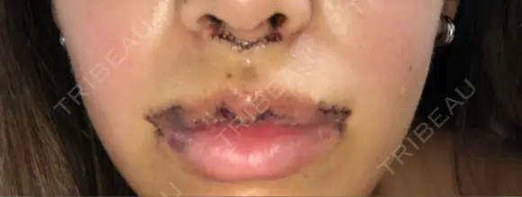 人中短縮 / 口角挙上 / その他（口元） 清潭女神美容外科 DAY 3 メイン用