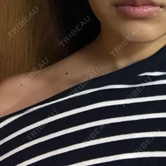 脂肪溶解注射（顔） / 美容点滴・美容注射（美肌） / ボトックス（肩） / ハイフ（顔） リエンジャン整形外科 江南店 DAY 3 メイン用