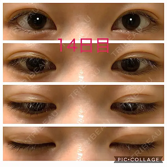 二重埋没 青山セレスクリニック 青山院 AFTER メイン用