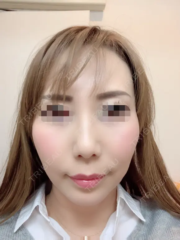 その他（目元） / クマ治療 / 額を丸く / その他（輪郭） / 下まぶたの脂肪取り / 脂肪注入（肌） / こめかみ形成 / 脂肪注入（額） / ヒアルロン酸注入（涙袋） / 脂肪注入（輪郭） / PRP皮膚再生療法 ジュエリー美容外科 DAY 34 メイン用