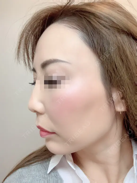 その他（目元） / クマ治療 / 額を丸く / その他（輪郭） / 下まぶたの脂肪取り / 脂肪注入（肌） / こめかみ形成 / 脂肪注入（額） / ヒアルロン酸注入（涙袋） / 脂肪注入（輪郭） / PRP皮膚再生療法 ジュエリー美容外科 DAY 34 メイン用