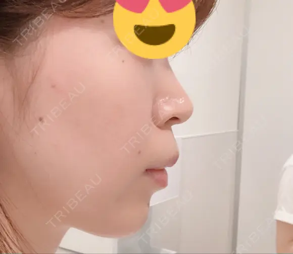 ボトックス（あご） / ヒアルロン酸注入（あご） / その他（輪郭） 品川美容外科 仙台院 DAY 3 メイン用