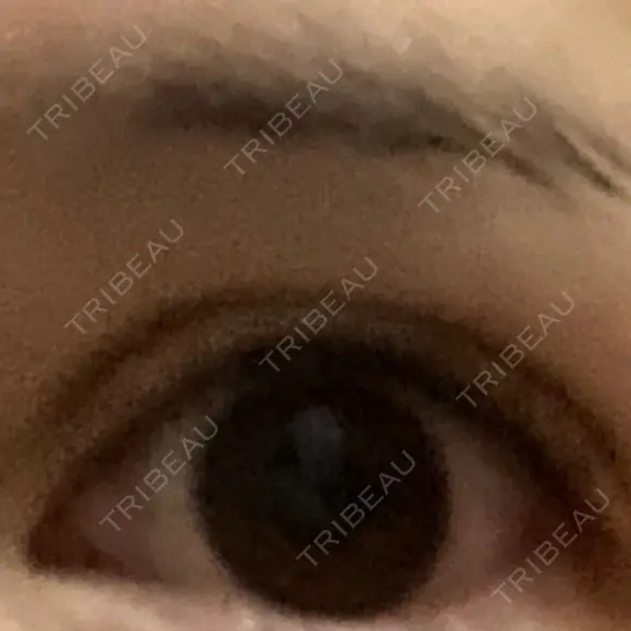 二重切開 牧野皮膚科形成外科内科医院 美容外科・形成外科・抗加齢医学外来 DAY 450 メイン用