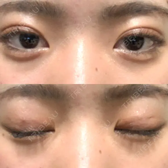 二重埋没 湘南美容クリニック 新宿本院 DAY 17 メイン用