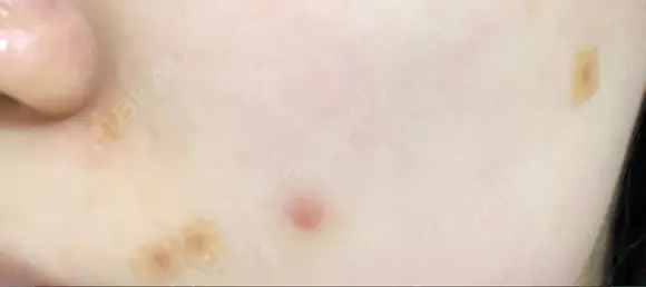 ほくろ・いぼ切除（肌） 赤坂メディカルMクリニック DAY 9 メイン用