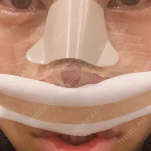 隆鼻術 / 鼻尖形成（切開） / 鼻中隔延長（切開） / 骨切幅寄せ / プロテーゼ除去 / 鼻修正 FROM B整形外科 (旧バウム整形外科) AFTER メイン用