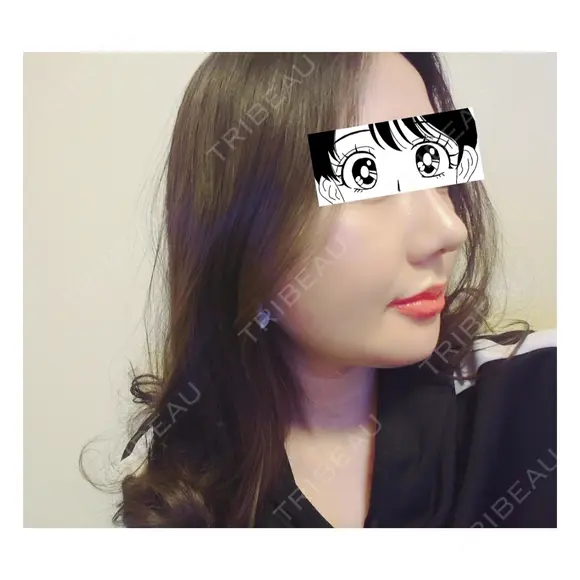 隆鼻術 / 鼻尖形成（切開） / 糸リフト / 骨削り（エラ） / 骨削り（頬） / 脂肪吸引（顔） RG整形外科（旧リオン整形外科） AFTER メイン用