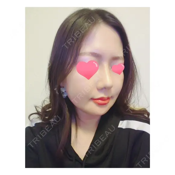 隆鼻術 / 鼻尖形成（切開） / 糸リフト / 骨削り（エラ） / 骨削り（頬） / 脂肪吸引（顔） RG整形外科（旧リオン整形外科） DAY 36 メイン用