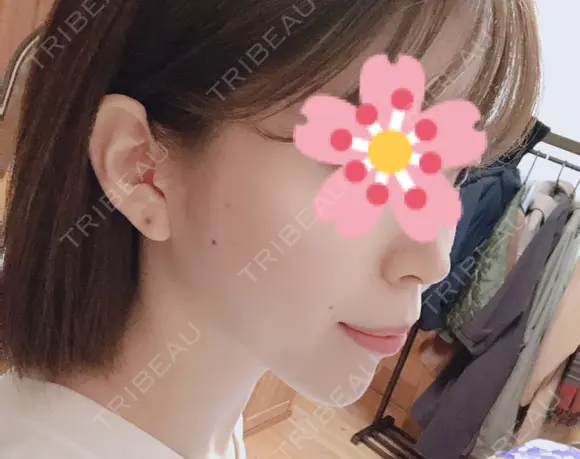 ボトックス（あご） / ヒアルロン酸注入（あご） / その他（輪郭） 品川美容外科 仙台院 DAY 4 メイン用