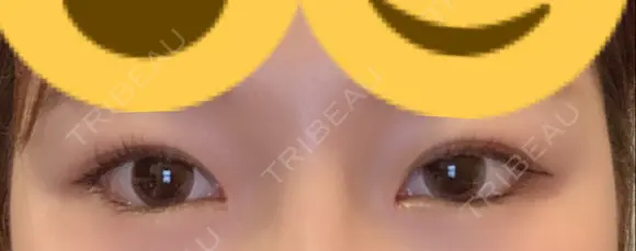 目頭切開 / 下まぶたの脂肪取り / タレ目形成・グラマラスライン（切開） ララ整形外科 DAY 16 メイン用