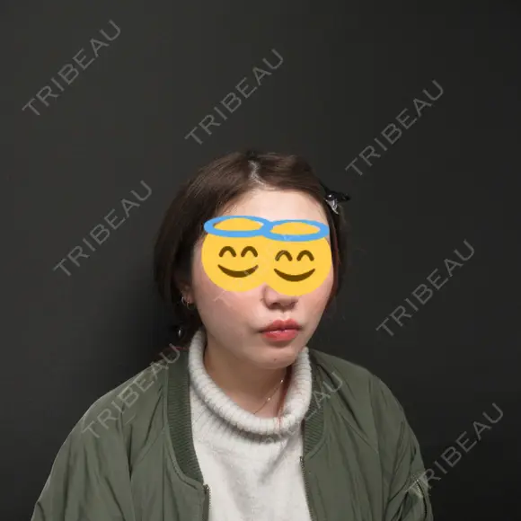 肌ヒアルロン酸注入（たるみ・シワ改善） / ボトックス（エラ・小顔） ジョウクリニック 姫路院 DAY 41 メイン用