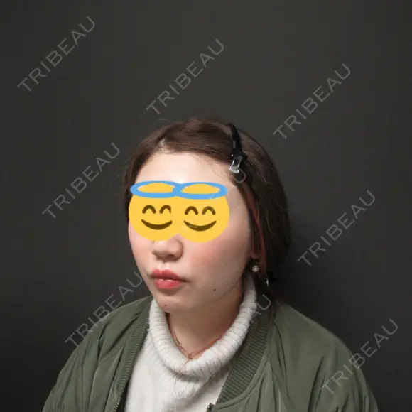 肌ヒアルロン酸注入（たるみ・シワ改善） / ボトックス（エラ・小顔） ジョウクリニック 姫路院 DAY 41 メイン用