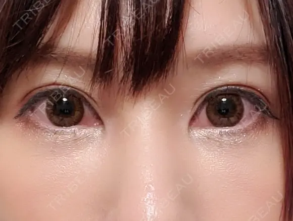 クマ治療 閉院｜プルージュ美容クリニック 赤羽院 DAY 1 メイン用