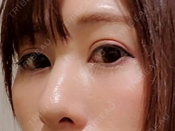 クマ治療 閉院｜プルージュ美容クリニック 赤羽院 DAY 30 メイン用