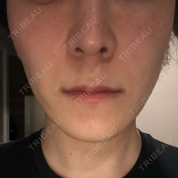 エレクトロポレーション 湘南美容クリニック 秋葉原院 DAY 5 メイン用