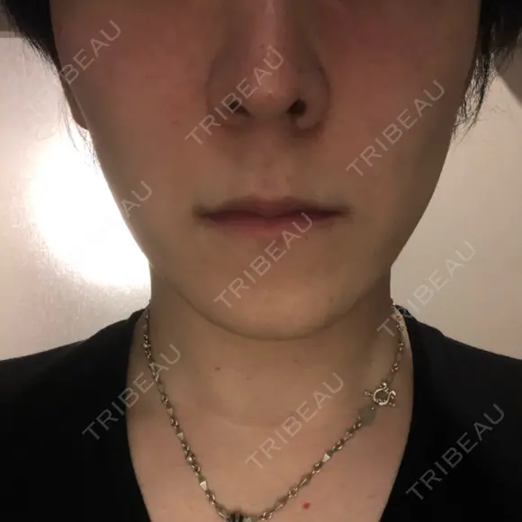 エレクトロポレーション 湘南美容クリニック 秋葉原院 DAY 6 メイン用