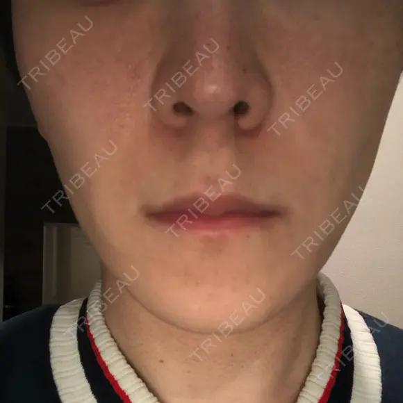 エレクトロポレーション 湘南美容クリニック 秋葉原院 DAY 7 メイン用