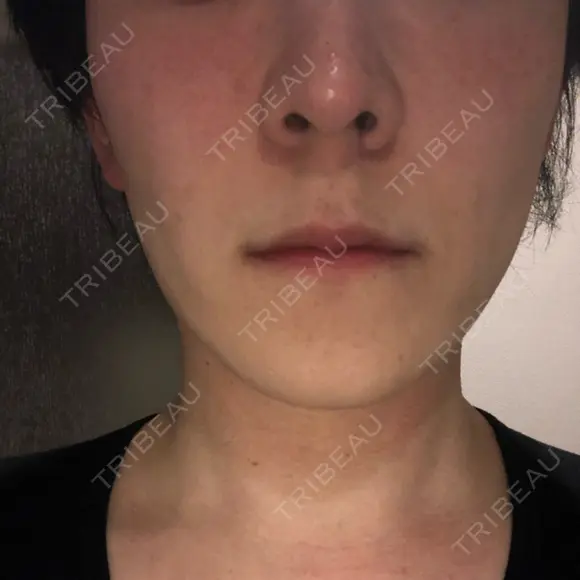 エレクトロポレーション 湘南美容クリニック 秋葉原院 DAY 9 メイン用