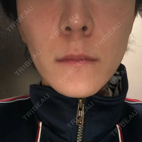 エレクトロポレーション 湘南美容クリニック 秋葉原院 AFTER メイン用