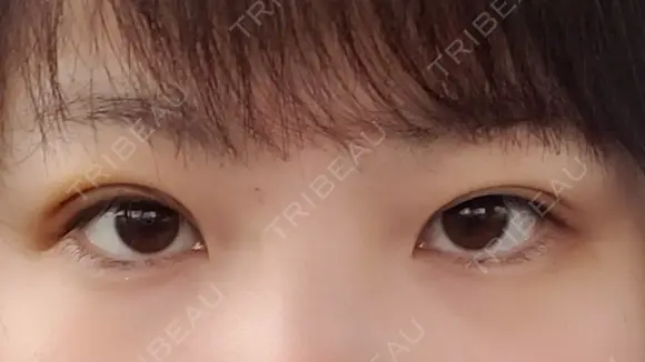 二重切開 / 上まぶたの脂肪取り 湘南美容クリニック 宇都宮院 DAY 14 メイン用