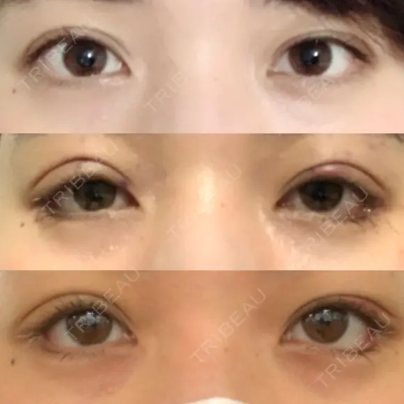 眼瞼下垂（切開） / 目尻切開 / タレ目形成・グラマラスライン（切開） プロミス整形外科 DAY 7 メイン用