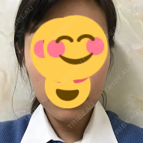 脂肪溶解注射（顔） / 美容点滴・美容注射（美肌） / ボトックス（肩） / ハイフ（顔） リエンジャン整形外科 江南店 DAY 9 メイン用