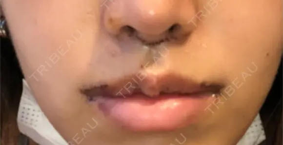 人中短縮 / 口角挙上 / その他（口元） 清潭女神美容外科 DAY 9 メイン用