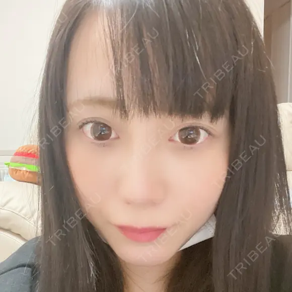 隆鼻術 / 鼻尖形成（切開） サラ美容外科 DAY 34 メイン用