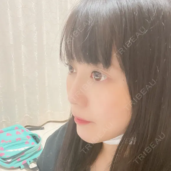 隆鼻術 / 鼻尖形成（切開） サラ美容外科 DAY 34 メイン用