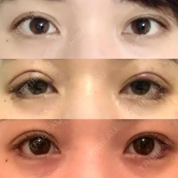 眼瞼下垂（切開） / 目尻切開 / タレ目形成・グラマラスライン（切開） プロミス整形外科 DAY 8 メイン用