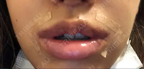 人中短縮 / 口角挙上 / その他（口元） 清潭女神美容外科 AFTER メイン用