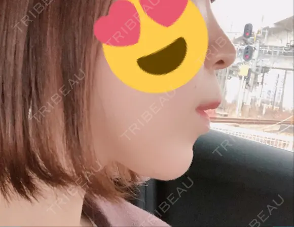 ボトックス（あご） / ヒアルロン酸注入（あご） / その他（輪郭） 品川美容外科 仙台院 DAY 10 メイン用