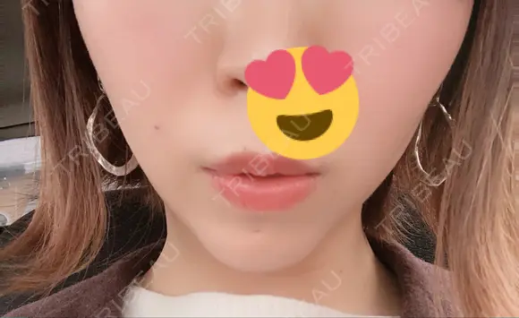 ボトックス（あご） / ヒアルロン酸注入（あご） / その他（輪郭） 品川美容外科 仙台院 DAY 10 メイン用