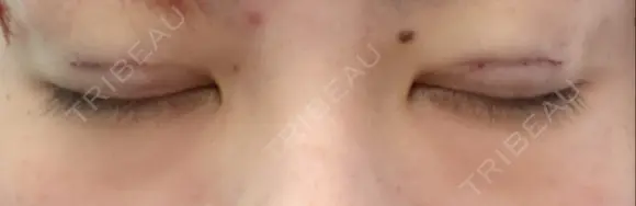 二重埋没 / 上まぶたの脂肪取り 湘南美容クリニック 柏院 DAY 0 メイン用