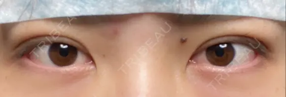 二重埋没 / 上まぶたの脂肪取り 湘南美容クリニック 柏院 DAY 0 メイン用