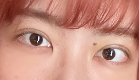 二重埋没 / 上まぶたの脂肪取り 湘南美容クリニック 柏院 DAY 2 メイン用