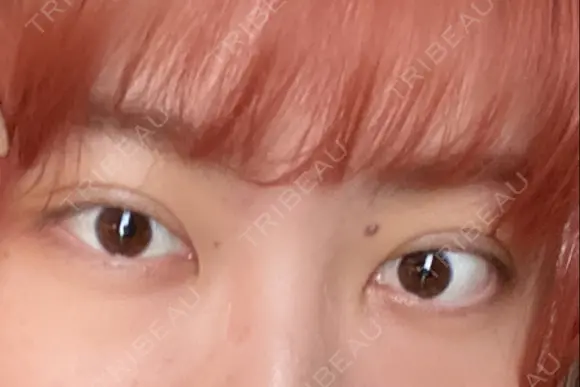 二重埋没 / 上まぶたの脂肪取り 湘南美容クリニック 柏院 DAY 2 メイン用