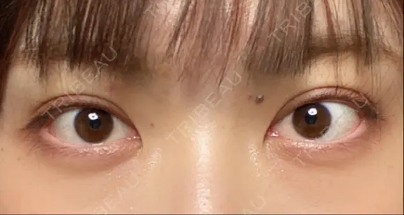 二重埋没 / 上まぶたの脂肪取り 湘南美容クリニック 柏院 AFTER メイン用