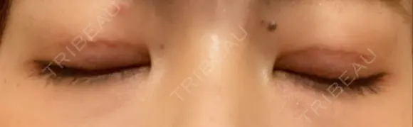 二重埋没 / 上まぶたの脂肪取り 湘南美容クリニック 柏院 DAY 11 メイン用