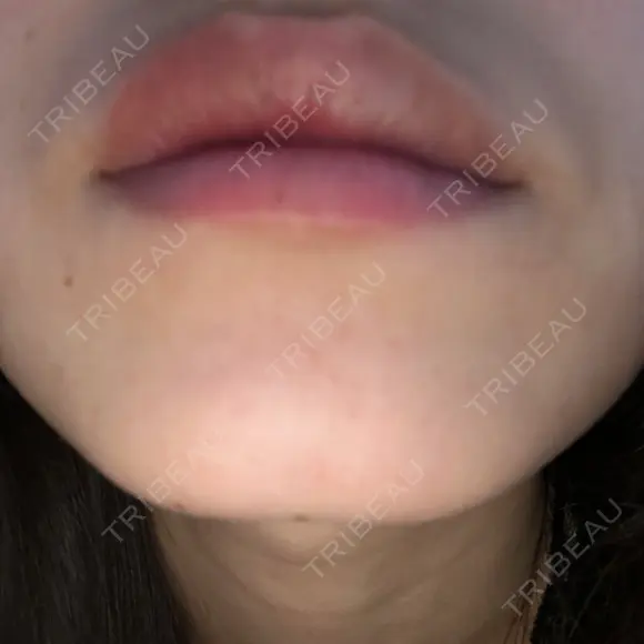 ボトックス（あご） TCB東京中央美容外科 京都駅前院 DAY 4 メイン用