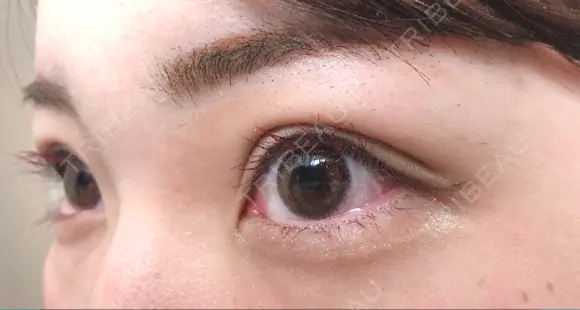 二重埋没 / 上まぶたの脂肪取り TCB東京中央美容外科 江坂院 DAY 29 メイン用