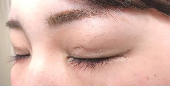 二重埋没 / 上まぶたの脂肪取り TCB東京中央美容外科 江坂院 DAY 29 メイン用