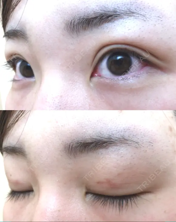 二重埋没 / 上まぶたの脂肪取り TCB東京中央美容外科 江坂院 DAY 29 メイン用