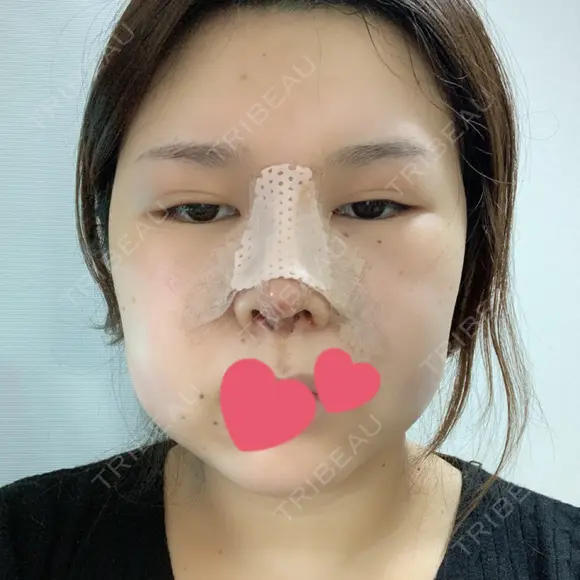 鼻中隔延長（切開） / 軟骨移植 / 眉間プロテーゼ FROM B整形外科 (旧バウム整形外科) DAY 2 メイン用