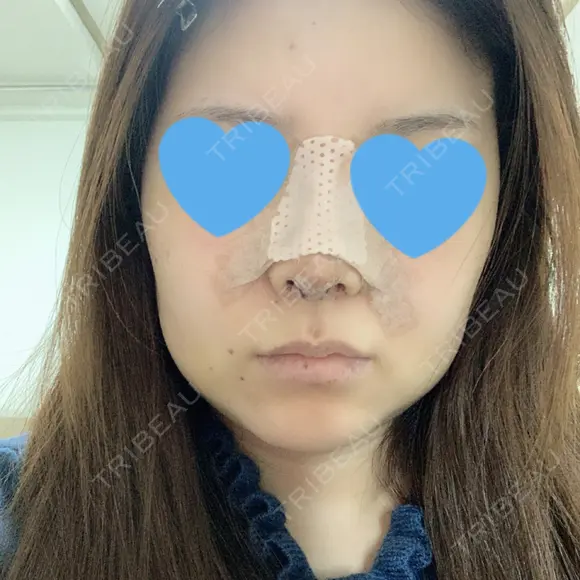 鼻中隔延長（切開） / 軟骨移植 / 眉間プロテーゼ FROM B整形外科 (旧バウム整形外科) DAY 4 メイン用