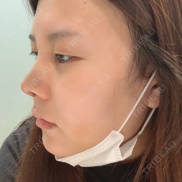 鼻中隔延長（切開） / 軟骨移植 / 眉間プロテーゼ FROM B整形外科 (旧バウム整形外科) DAY 5 メイン用