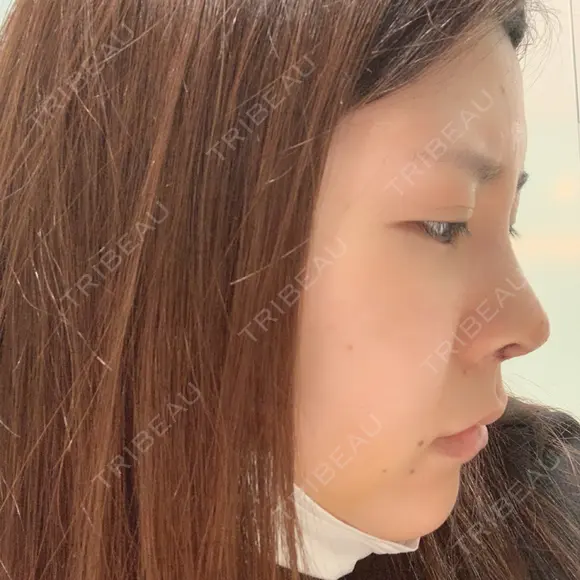 鼻中隔延長（切開） / 軟骨移植 / 眉間プロテーゼ FROM B整形外科 (旧バウム整形外科) DAY 5 メイン用