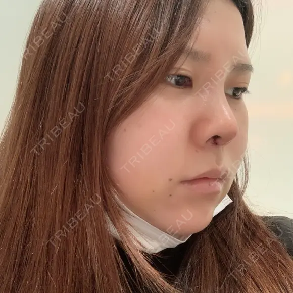 鼻中隔延長（切開） / 軟骨移植 / 眉間プロテーゼ FROM B整形外科 (旧バウム整形外科) DAY 5 メイン用