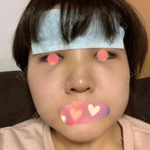 バッカルファット除去 湘南美容クリニック 新潟院 DAY 2 メイン用